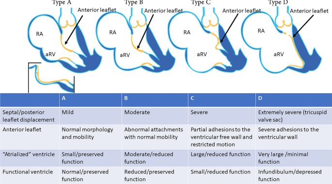 RV Global Longitudinal Strain a Predictor of Mortality in Ebstein