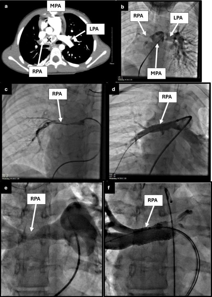 Cardiovascular Manifestations and Interventions in Children Living in a ...