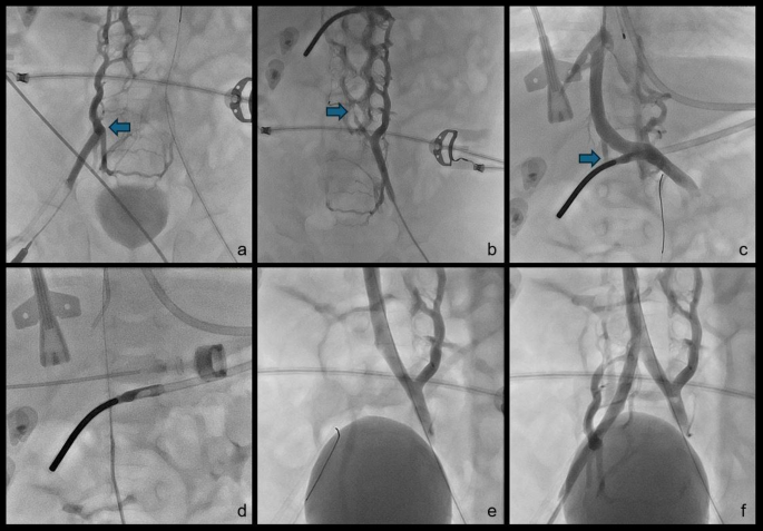 Transcatheter Management of Pulmonary Vein Stenosis in Children ...