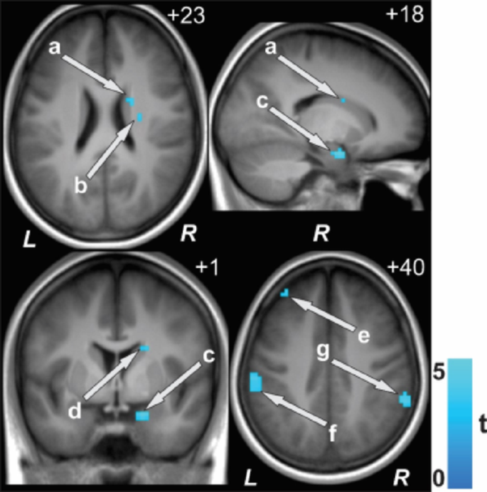Neural Changes in Adolescents with Single Ventricle Congenital Heart ...