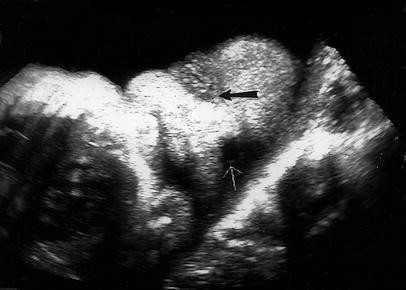 Fetal Dacryocystocele Comparing 2d And 3d Imaging Springerlink