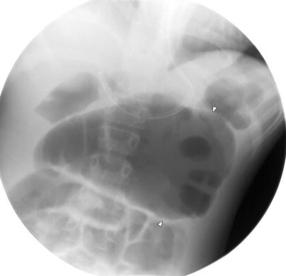 Cecal Volvulus A Rare Cause Of Bowel Obstruction In A Pediatric Patient Diagnosed Pre Operatively By Conventional Imaging Studies Springerlink