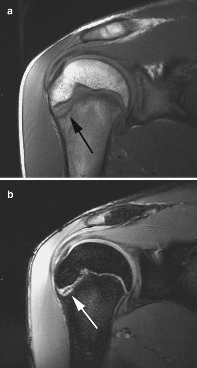 Little League Shoulder/Elbow