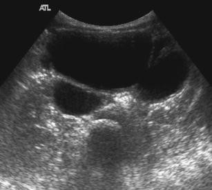 Multiple Bladder Diverticula In Menkes Disease Springerlink