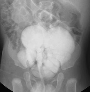 Multiple bladder diverticula in Menkes disease | SpringerLink Multiple bladder diverticula in Menkes disease | SpringerLink