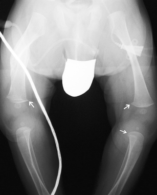 Long-term skeletal findings in Menkes disease | SpringerLink Long-term skeletal findings in Menkes disease | SpringerLink