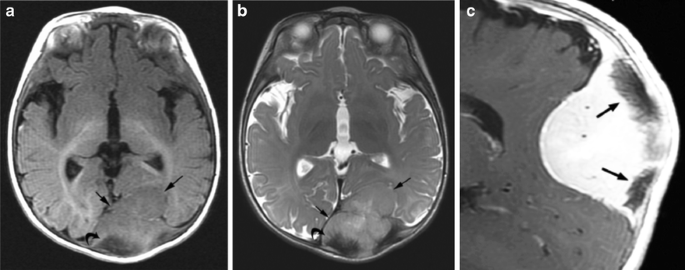 Melanotic neuroectodermal tumour of infancy: CT and MR findings | Pediatric  Radiology
