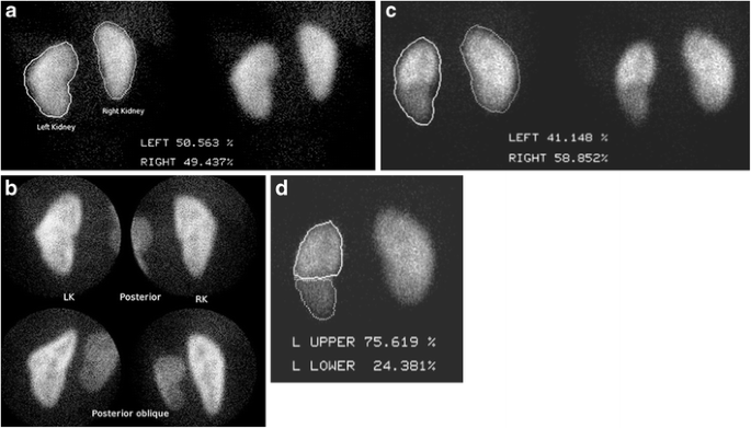 Scintigraphic features of duplex kidneys on DMSA renal cortical scans |  SpringerLink