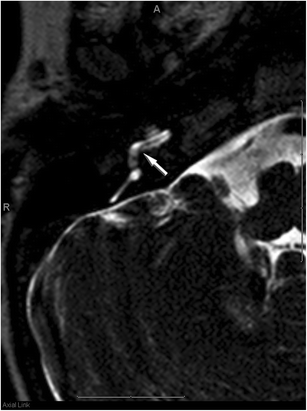 UW Team Creates “One-Stop-Shop” for Stroke Treatment – Department of  Radiology – UW–Madison