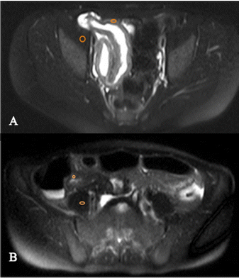 UW Team Creates “One-Stop-Shop” for Stroke Treatment – Department of  Radiology – UW–Madison