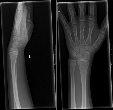 Clinical photograph of the right wrist of a 35-yearold male