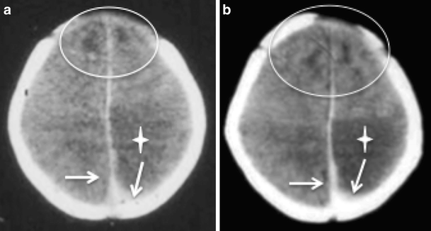 pdf perdarahan subarachnoid pdf perdarahan subarachnoid