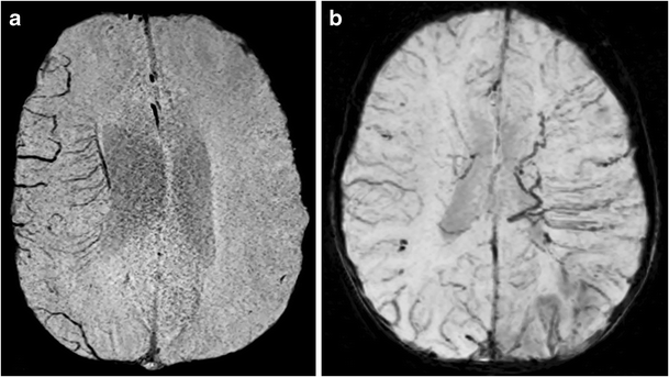 Brush Sign In Sturge Weber Syndrome Springerlink