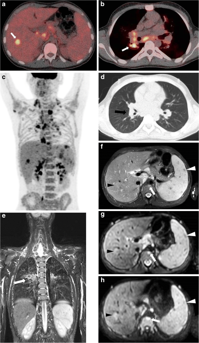 hodgkins lymphoma radiology