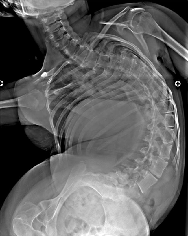 Cerebral palsy — beyond hip deformities | Pediatric Radiology