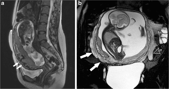 Placental magnetic resonance imaging Part II: placenta accreta spectrum |  SpringerLink