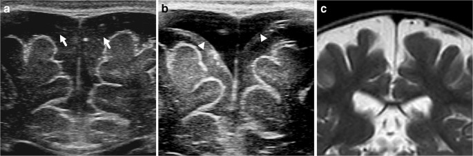 macrocephaly ultrasound