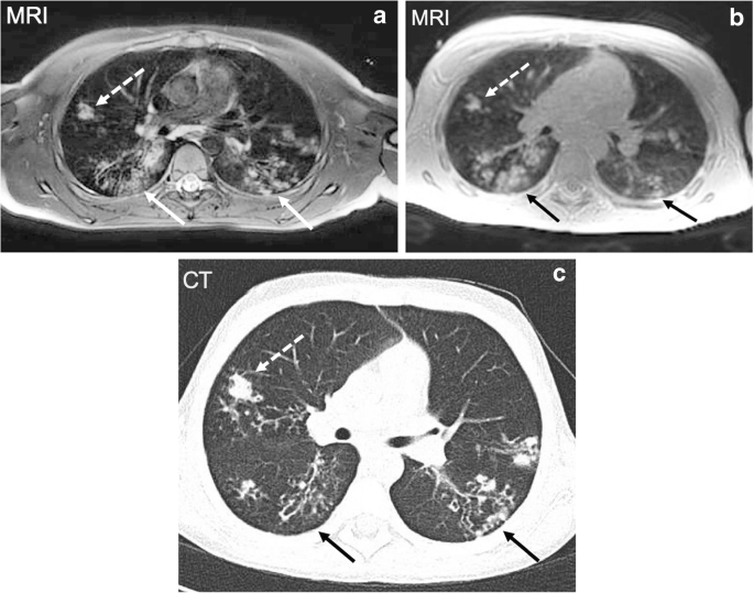 Practical Protocol For Lung Magnetic Resonance Imaging And Common Clinical Indications Springerlink
