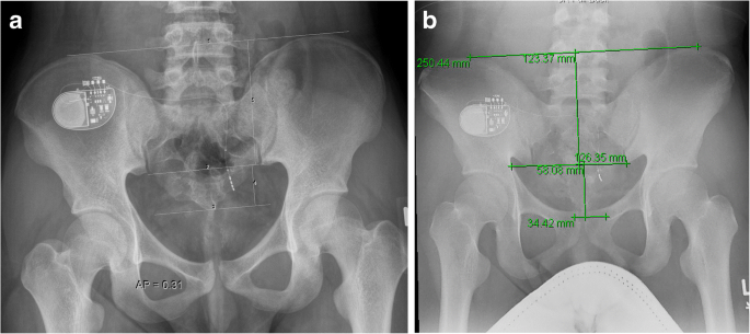 Correlation between the lateral and anteroposterior sacral ...