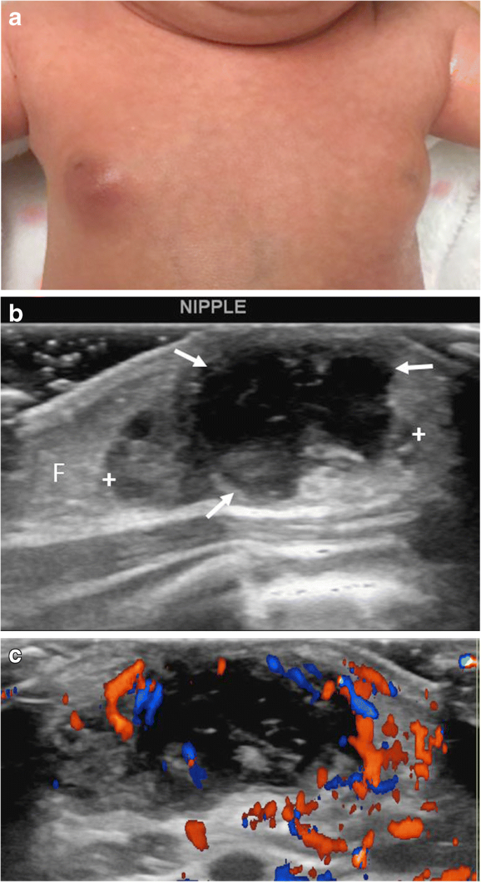 girls developing breast Breast development in pediatric patients from birth to puberty: physiology,  pathology and imaging correlation | Pediatric Radiology