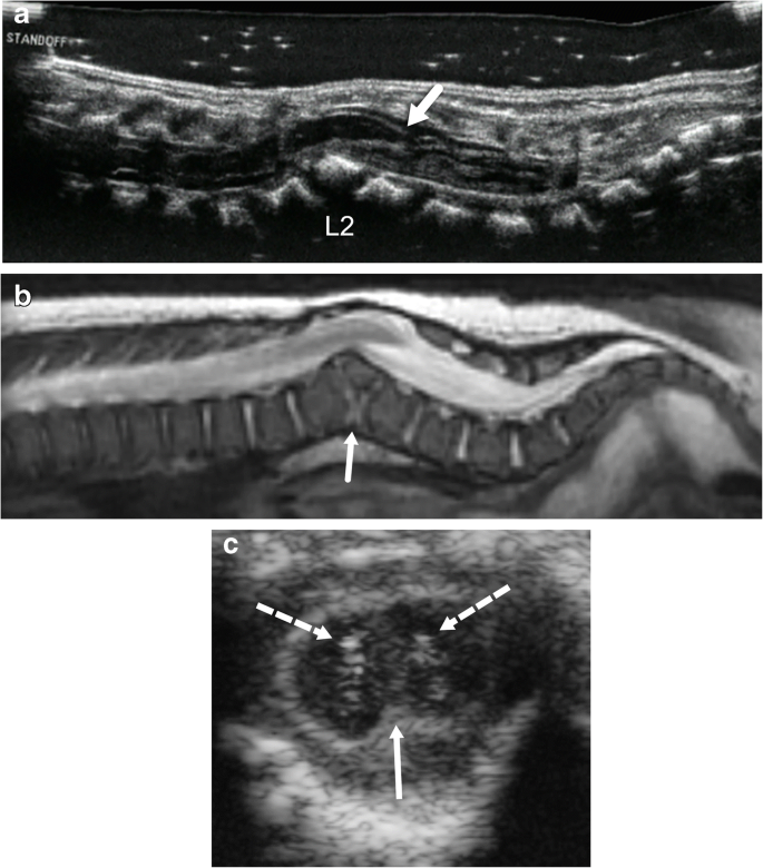 Congenital spinal dermal tract: how accurate is clinical and radiological  evaluation? in: Journal of Neurosurgery: Pediatrics Volume 15 Issue 6  (2015) Journals