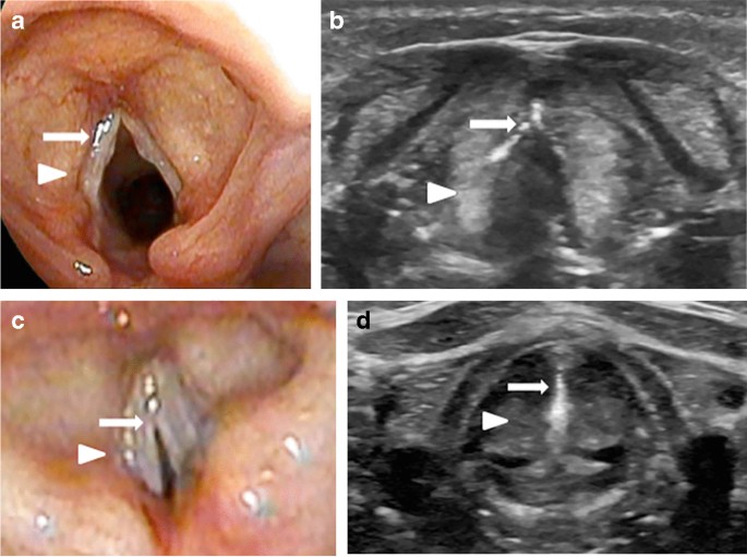 Ultrasound of the vocal cords in infants | SpringerLink