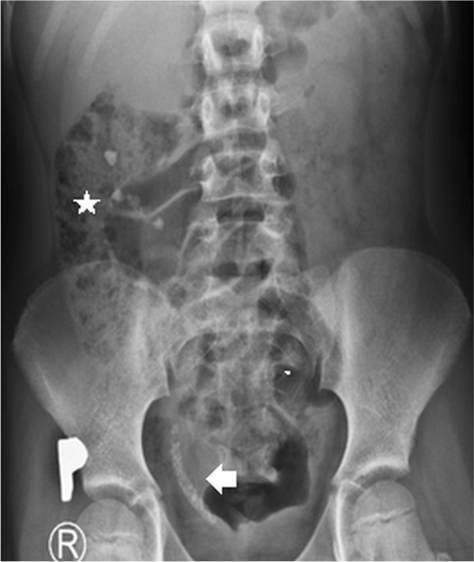 Teenager with right flank pain, Pediatric Radiology Case, Pediatric  Imaging