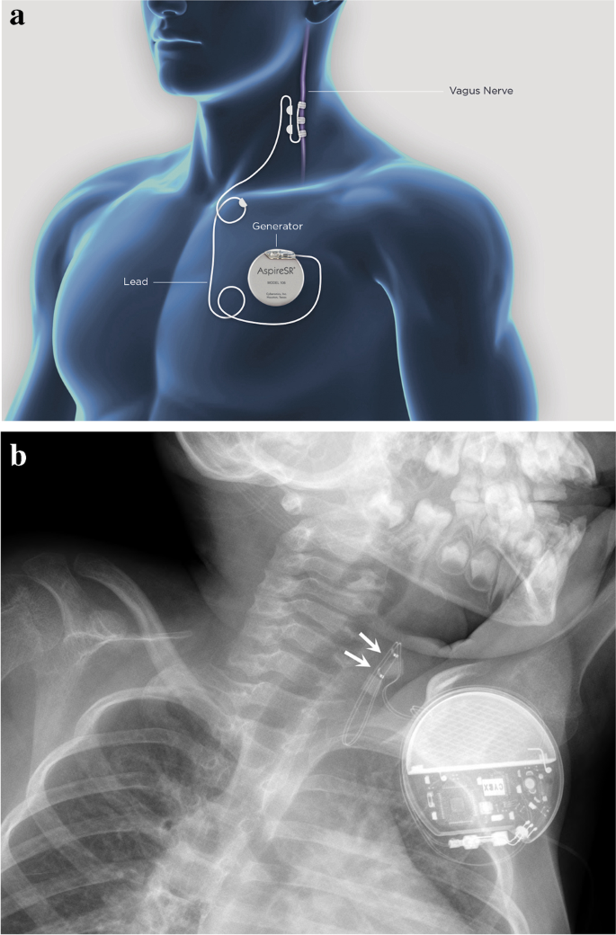 MR Safety: Respiratory Stimulators - Questions and Answers ​in MRI