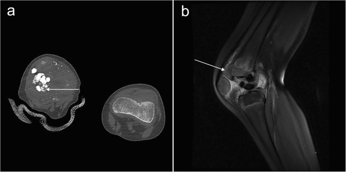 Tumoral calcinosis with epiphyseal involvement in the knee | Pediatric ...