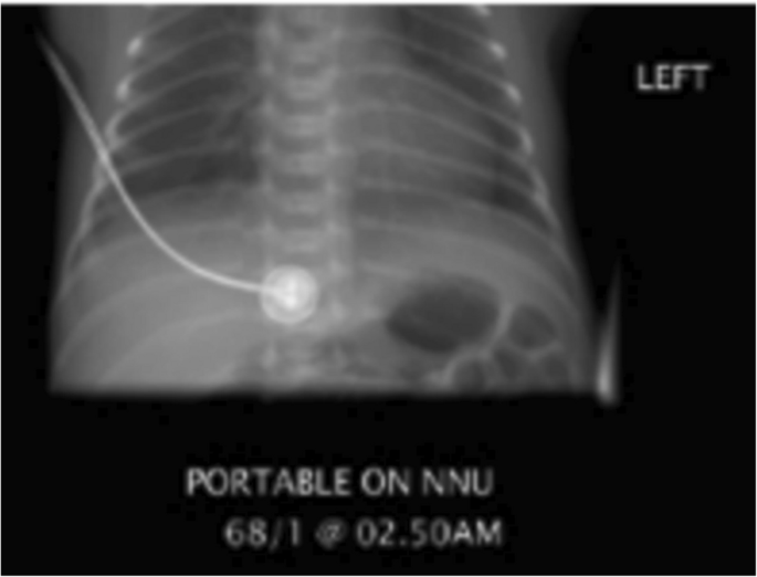 Anatomical marker placement in mobile neonatal chest radiographs ...
