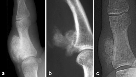 Nora's lesion, a distinct radiological entity? | SpringerLink