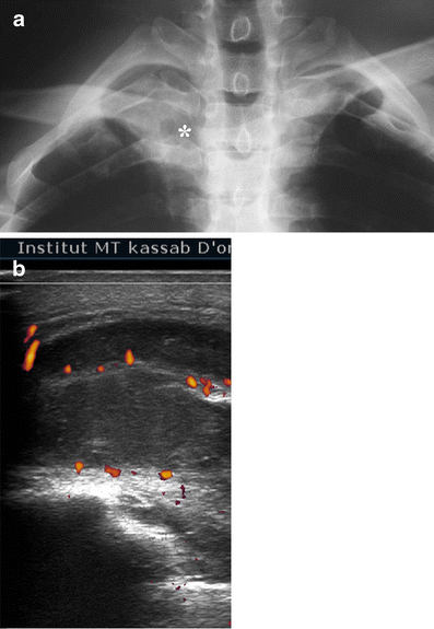 Imaging of chest wall infections | SpringerLink