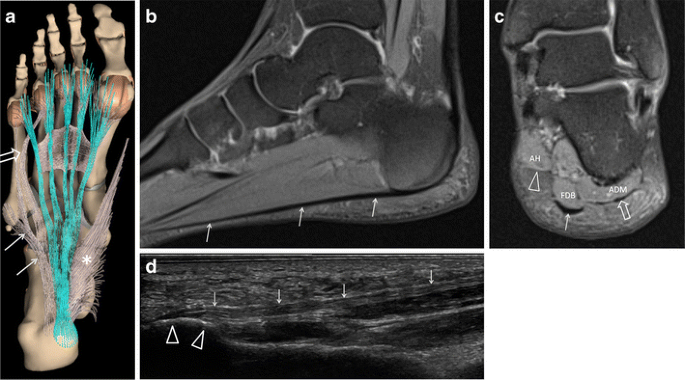 Imaging of plantar fascia and Achilles injuries undertaken at the London  2012 Olympics | Skeletal Radiology