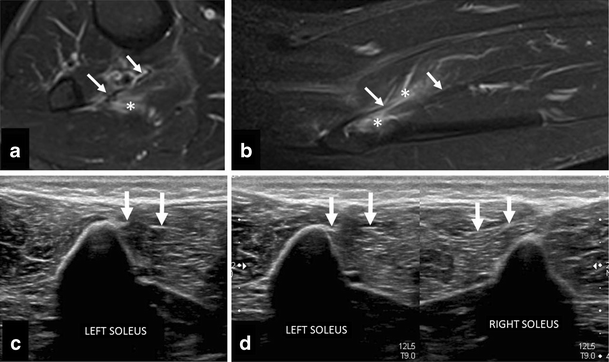Soleus muscle injury: sensitivity of ultrasound patterns | SpringerLink