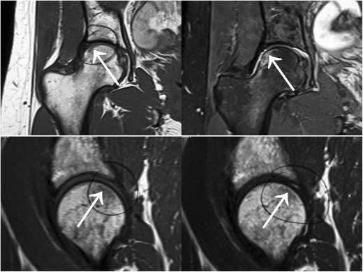 MRI of subchondral fractures: a review | SpringerLink
