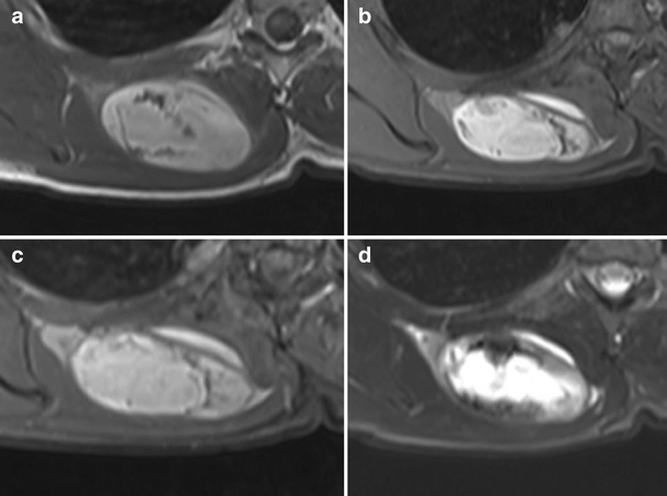 melanotic schwannoma radiology Melanotic schwannoma: an 11-year case series | Skeletal Radiology