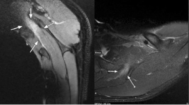 MRI for the diagnosis of scapular dyskinesis: a report of two cases |  SpringerLink