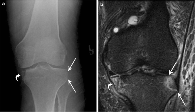 iliotibial band syndrome x ray ízületek éles térdfájdalma