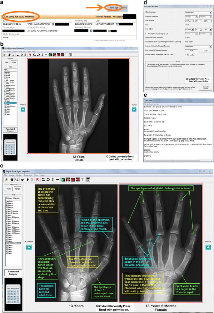 Skeletal development of the hand and wrist: digital bone age companion—a  suitable alternative to the Greulich and Pyle atlas for bone age  assessment? | SpringerLink