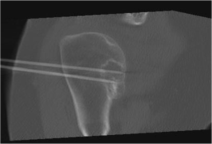 Radiofrequency ablation in the treatment of atypical cartilaginous tumours  in the long bones: lessons learned from our experience | SpringerLink