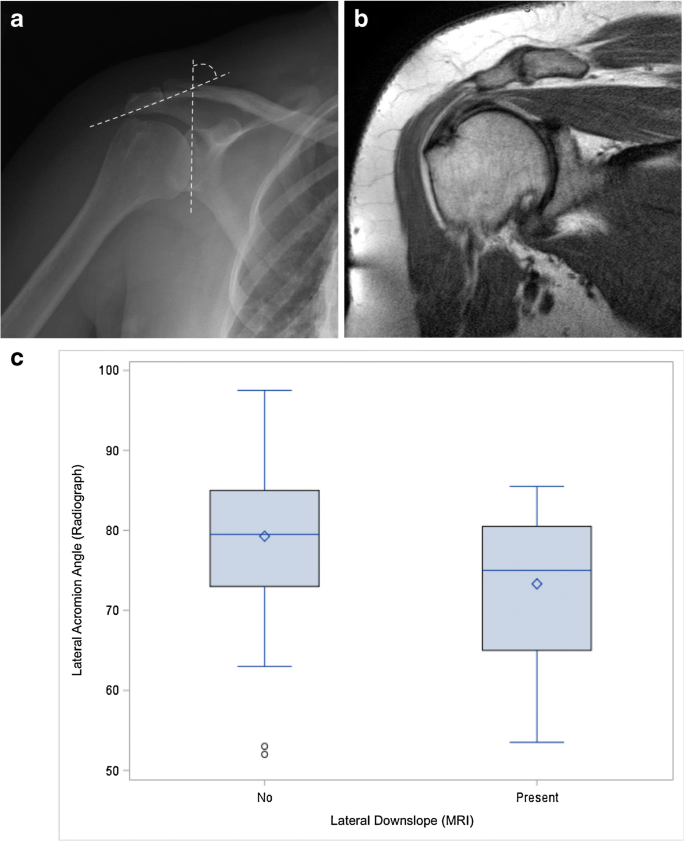 Subacromial impingement anatomy and its association with rotator pathology in women: radiograph MRI correlation, a retrospective evaluation SpringerLink