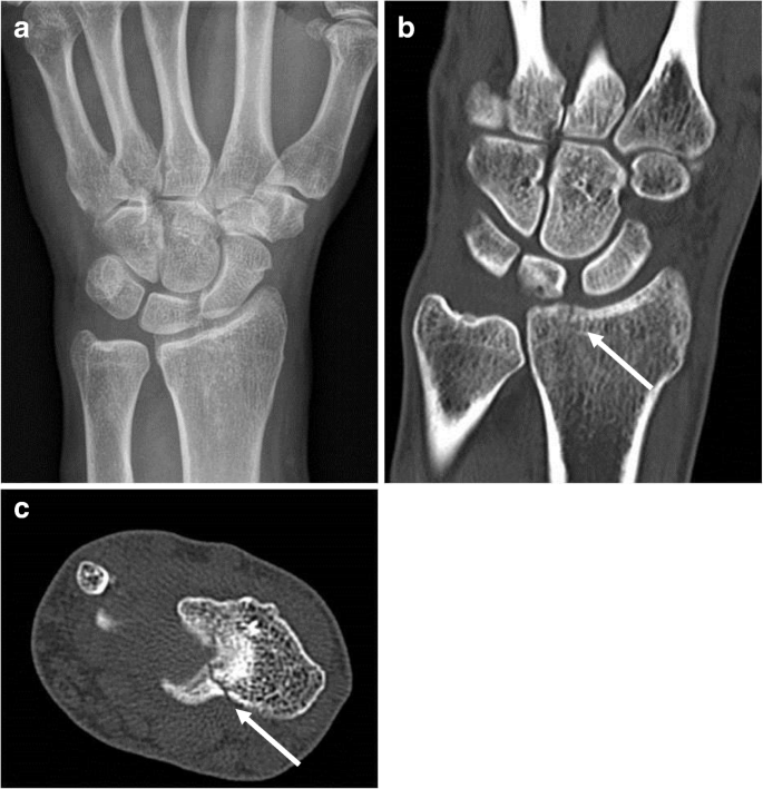 Scaphoid fracture ct scan, 40+ Rtg ideas | radiológia, anatómia, elsősegély