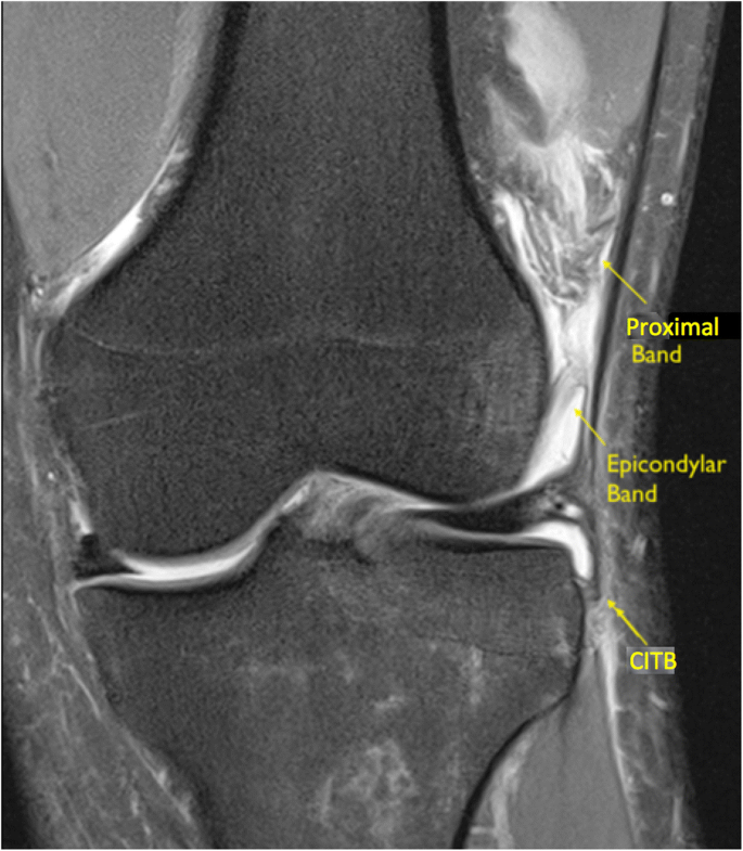 Magnetic resonance imaging appearances of the capsulo-osseous layer of the iliotibial  band and femoral attachments of the iliotibial band in the normal and  pivot-shift ACL injured knee | SpringerLink