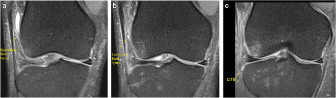 Magnetic resonance imaging appearances of the capsulo-osseous layer of the  iliotibial band and femoral attachments of the iliotibial band in the  normal and pivot-shift ACL injured knee | SpringerLink