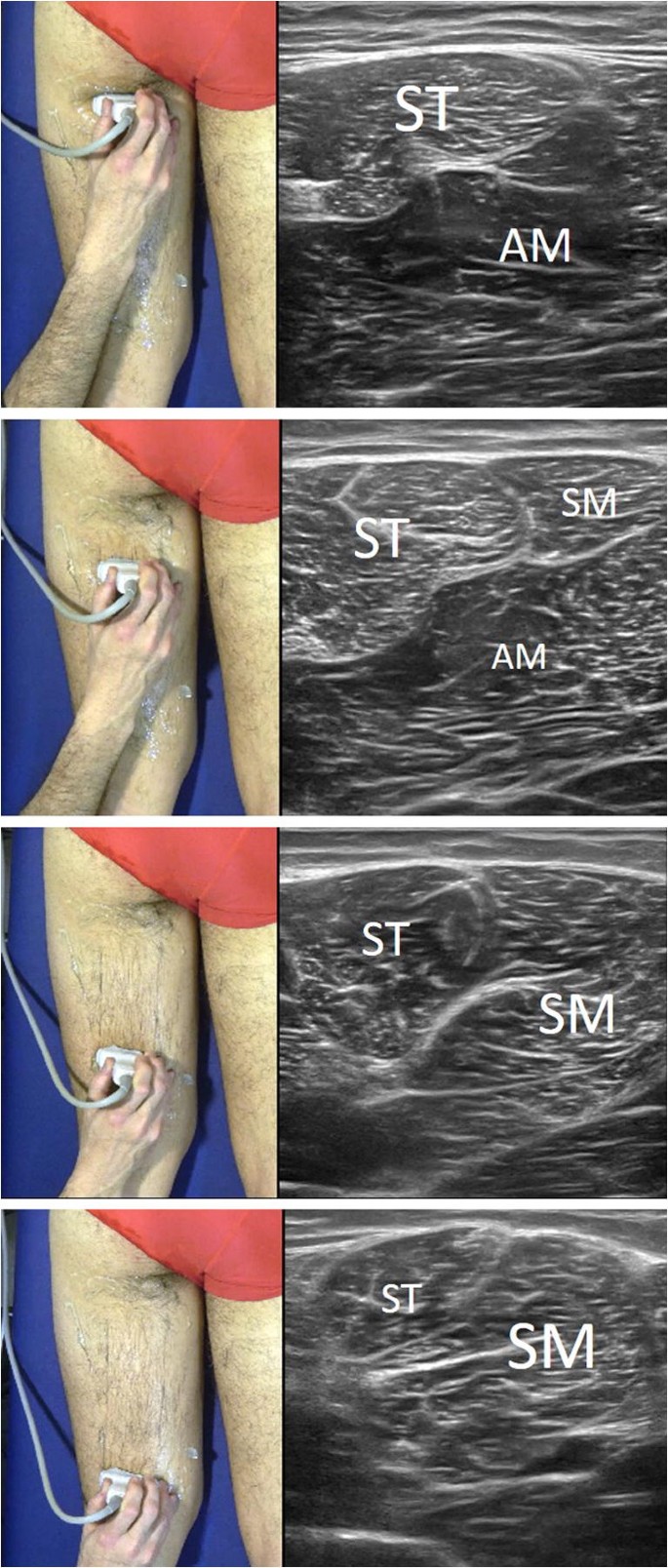 Sonographic Landmarks In Hamstring Muscles Springerlink