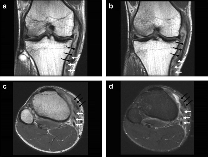 Tears in the distal superficial medial collateral ligament: the wave sign  and other associated MRI findings | SpringerLink
