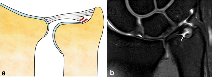 images Tfcc Tear Mri triangular fibrocartilage complex tfcc