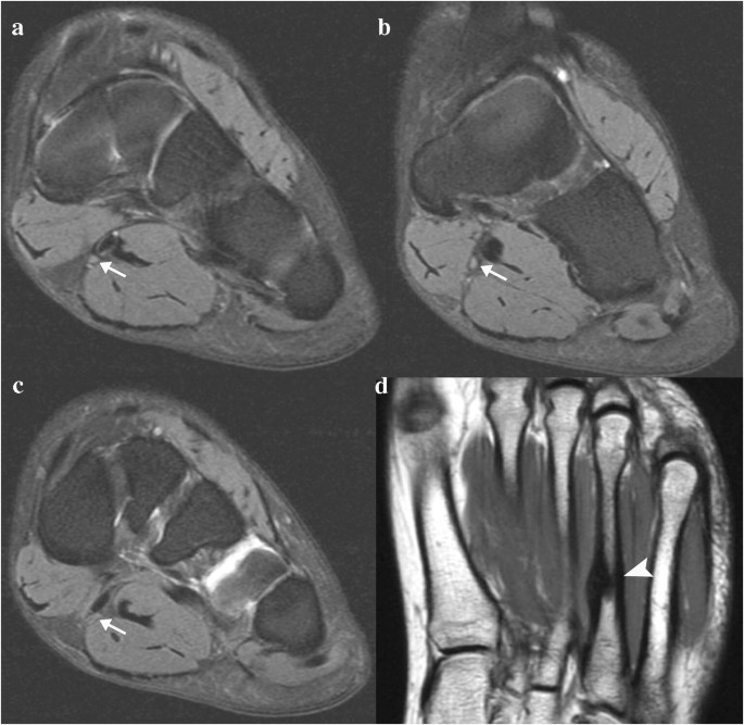 Mri Appearance Of Jogger S Foot Springerlink