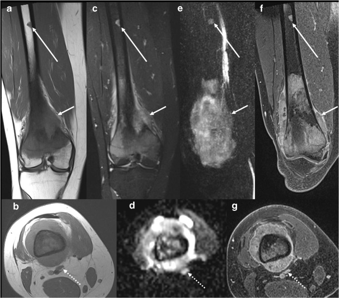 popliteal lymph nodes mri