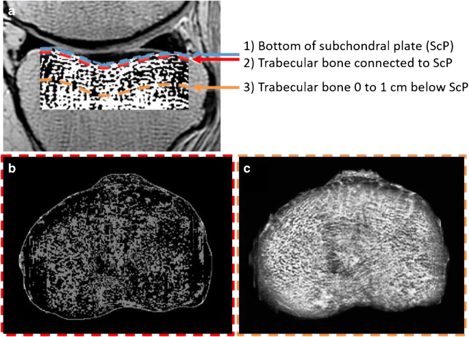 Mr Imaging Pattern Of Tibial Subchondral Bone Structure Considerations Of Meniscal Coverage And Integrity Springerlink Mr Imaging Pattern Of Tibial Subchondral Bone Structure Considerations Of Meniscal Coverage And Integrity Springerlink